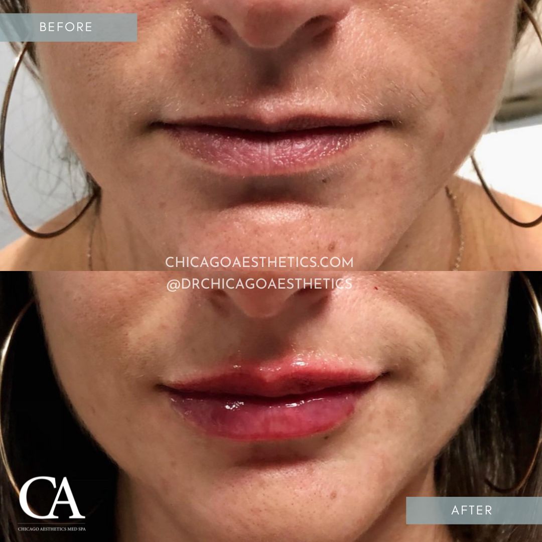 #318 Lip Filler Before After Chicago Aesthetics