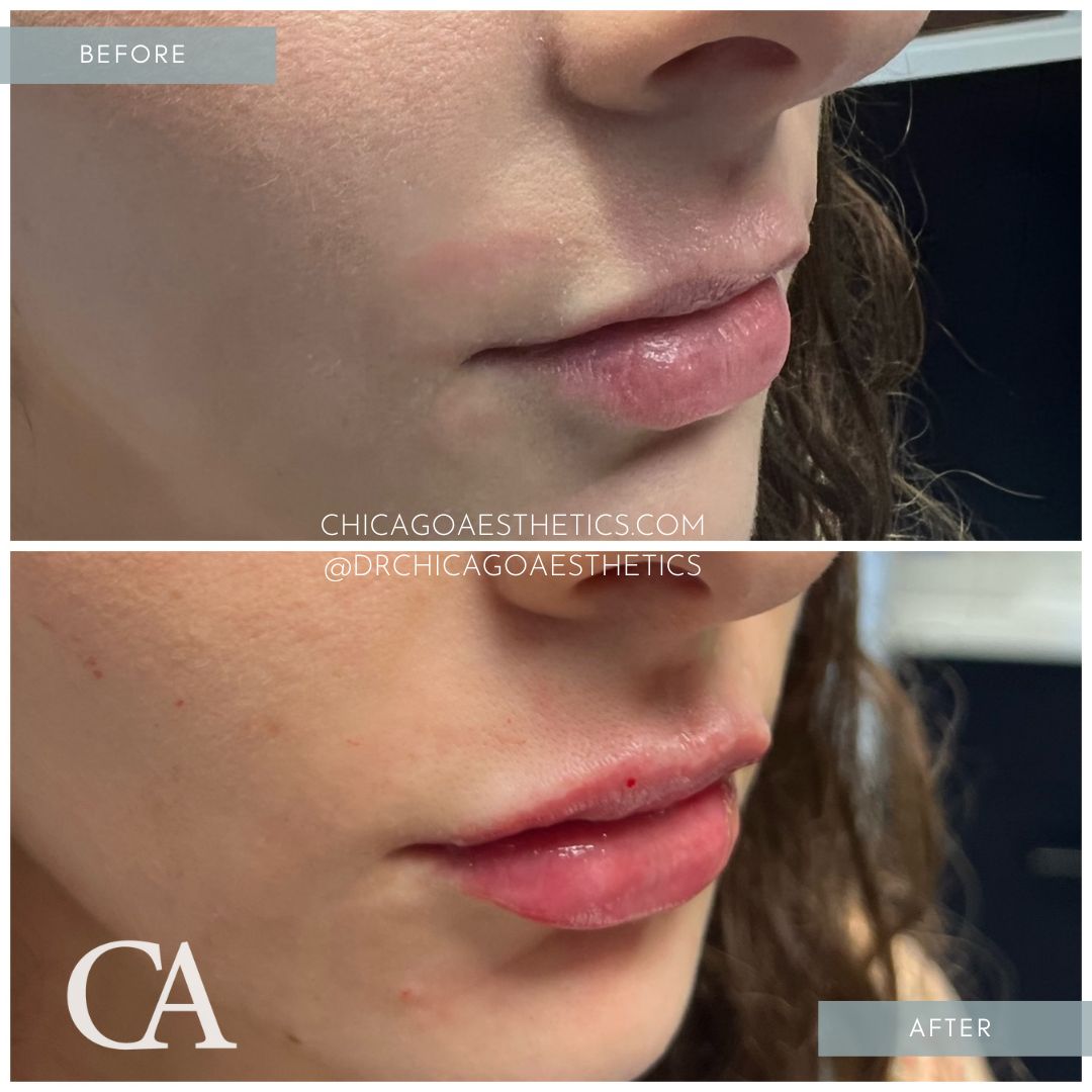 #319 Lip Filler Before After Chicago Aesthetics