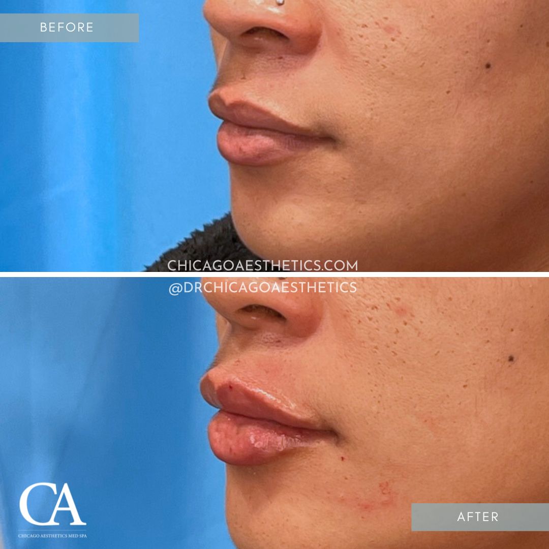#320 Lip Filler Before After Chicago Aesthetics