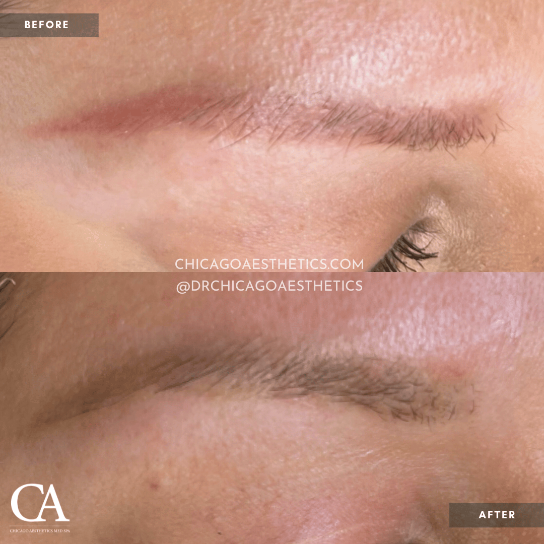 #407 Permanent Makeup Before After Chicago Aesthetics