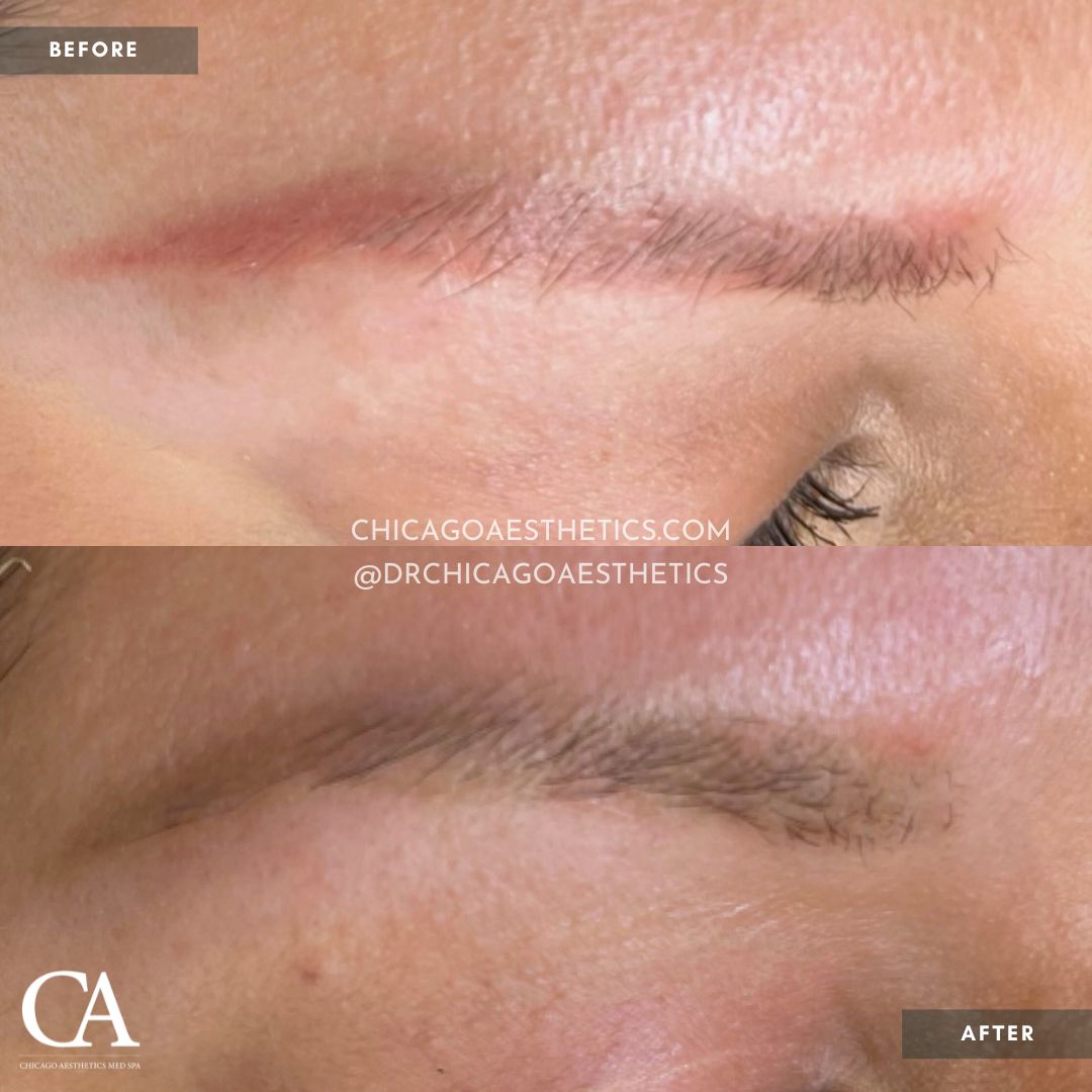 #407 Permanent Makeup Eyebrow Removal Before After Chicago Aesthetics