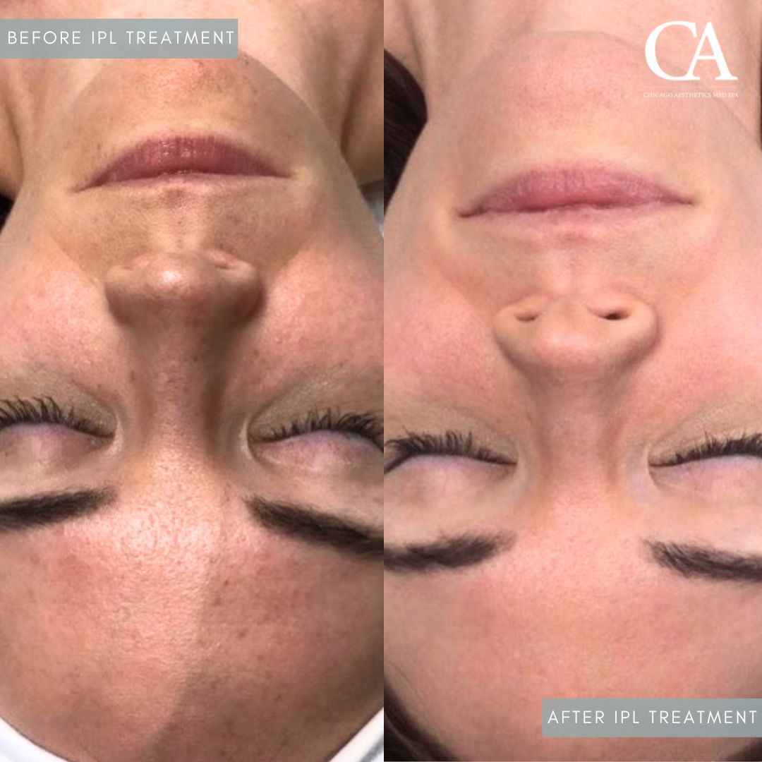 #409 IPL Treatment Before After Chicago Aesthetics