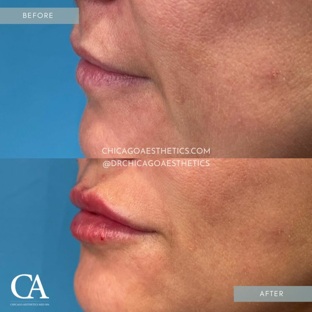 #413 Lip Filler Before After Chicago Aesthetics