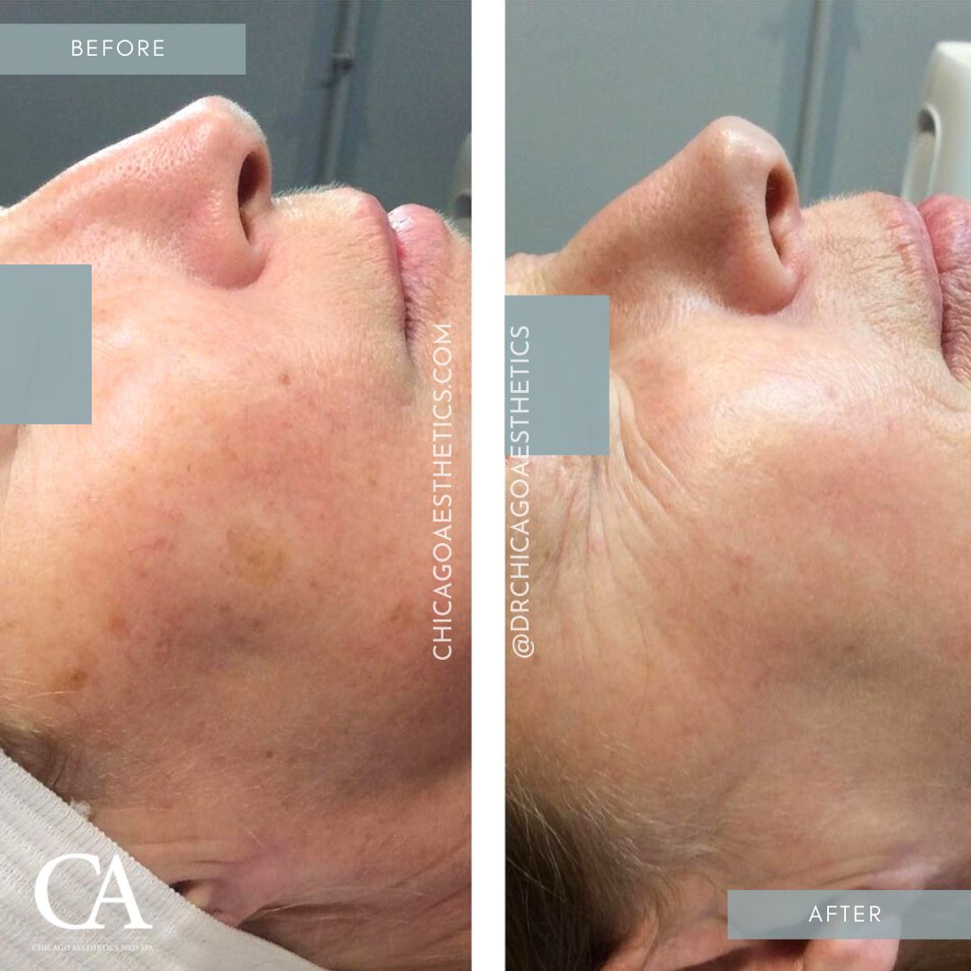 #415 IPL Treatment Before After Chicago Aesthetics