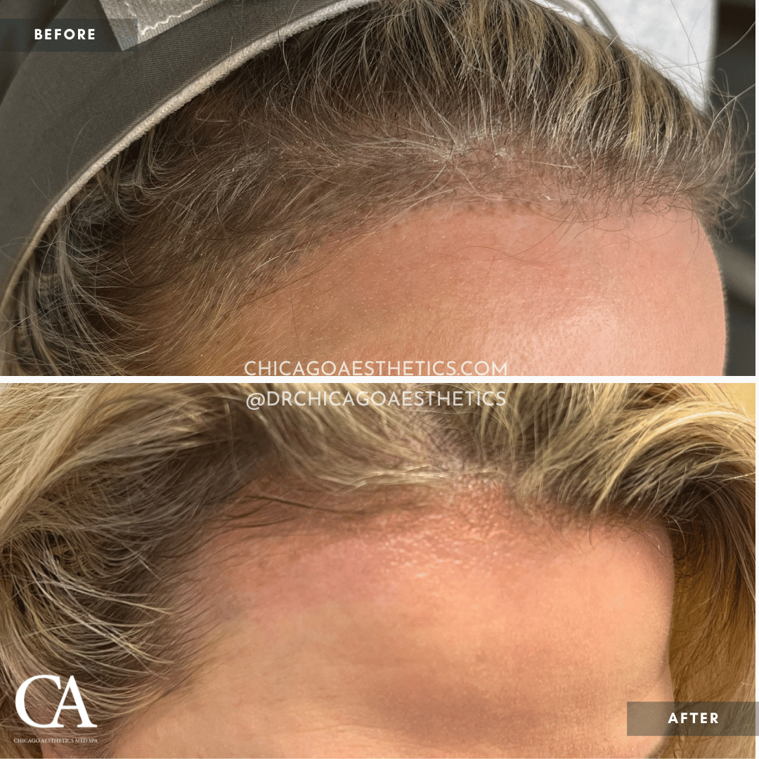 #500 Permanent Makeup Before After Chicago Aesthetics