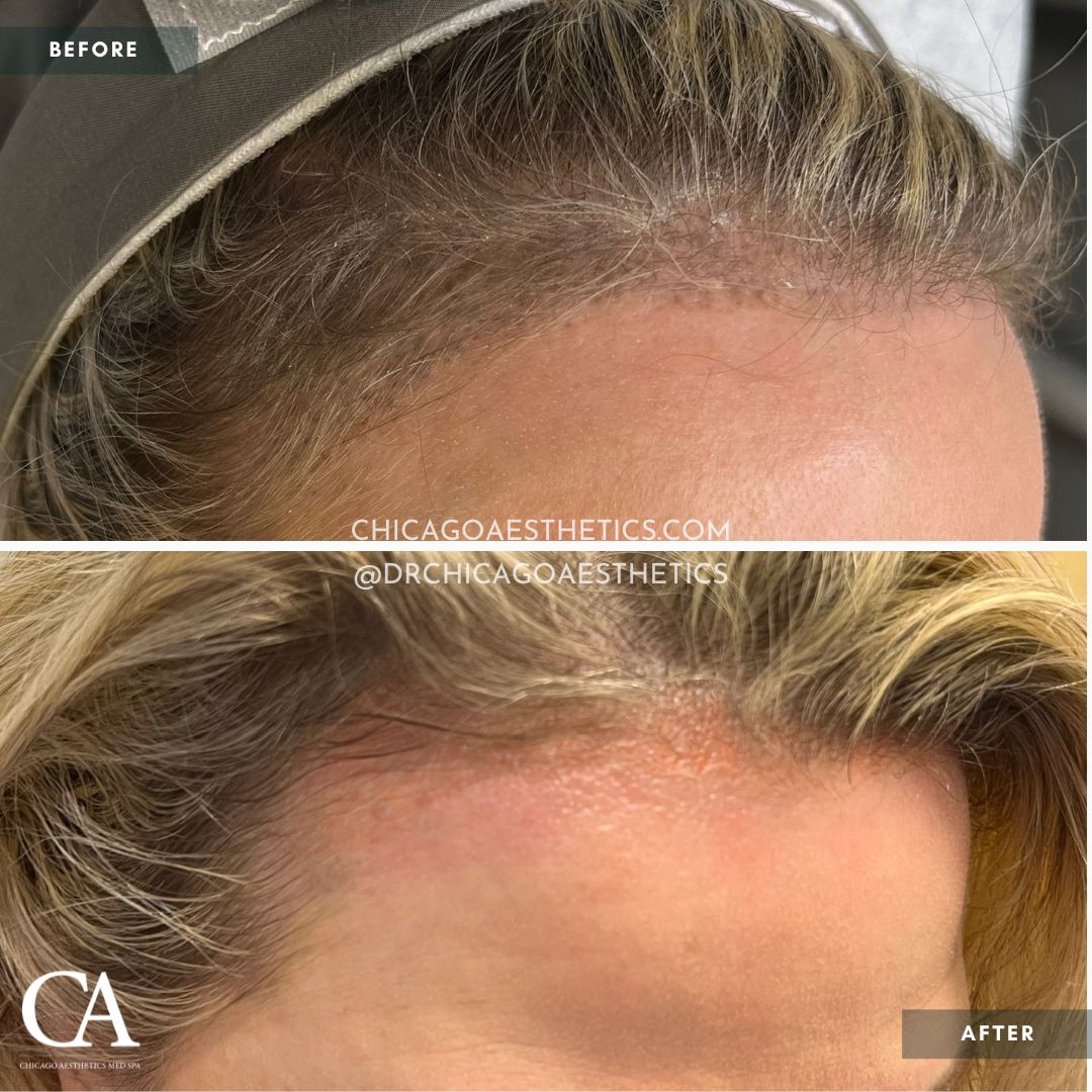 #500 Permanent Makeup Removal Before After Chicago Aesthetics