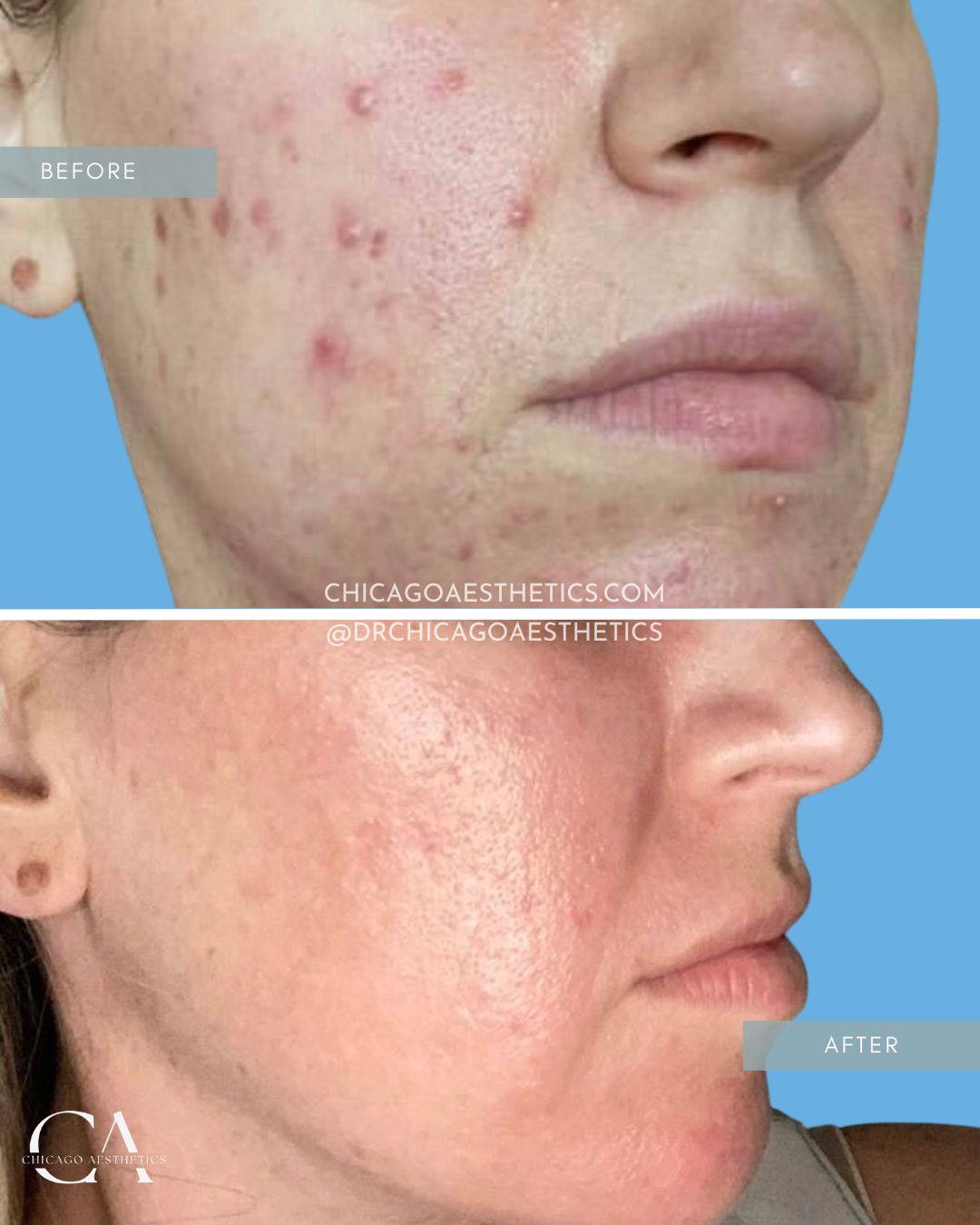 A woman's face with acne before and after MICRONEEDLING treatment, captured in Before After Photos.