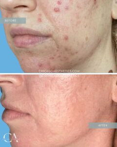 #417 Microneedling Before and After Chicago Aesthetics
