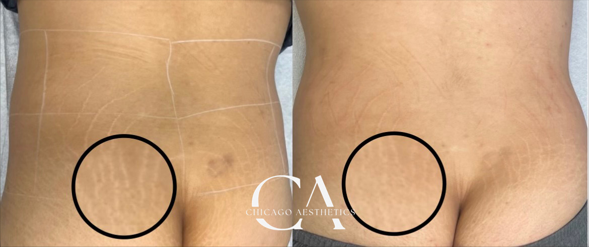 Before and after picture of a woman's stretch marks after laser treatment at Chicago Aesthetics