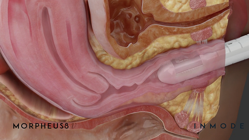 A 3D image of a woman's abdomen undergoing Morpheus8V treatment.