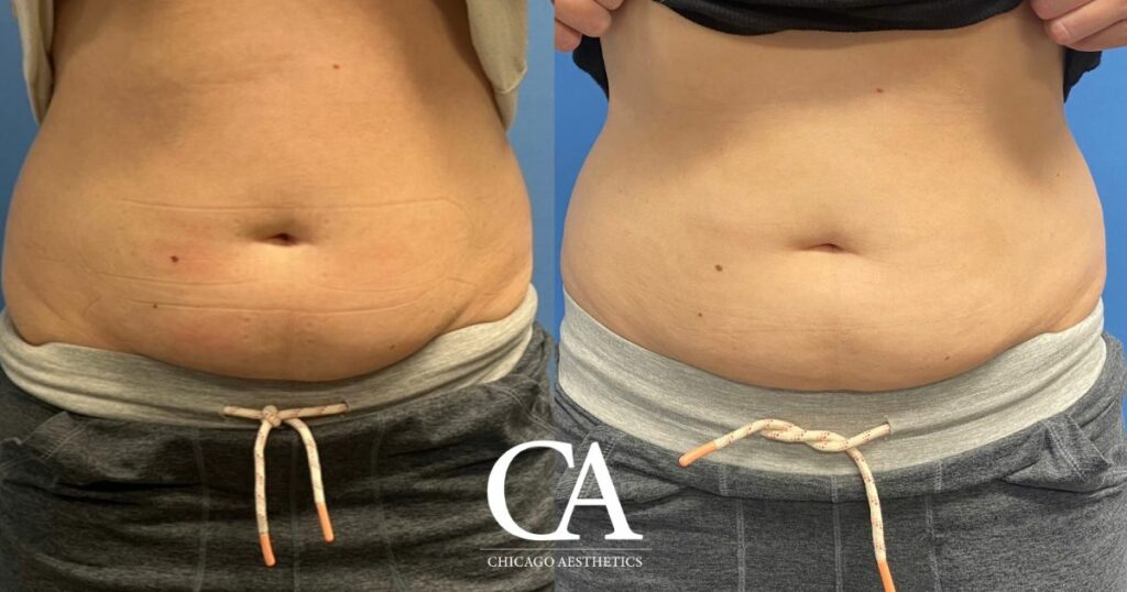 #644 Sculpsure before after photo - Chicago Aesthetics