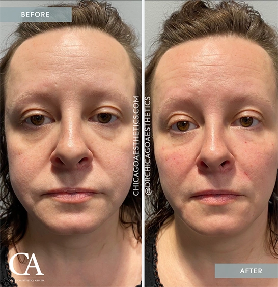 Before and after photos showcasing the transformative effects of dermal fillers on a woman's face.