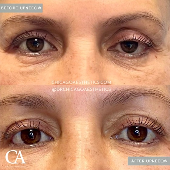 Before and after photos showcasing the transformative effects of dermal fillers on a patient's eyelids.
