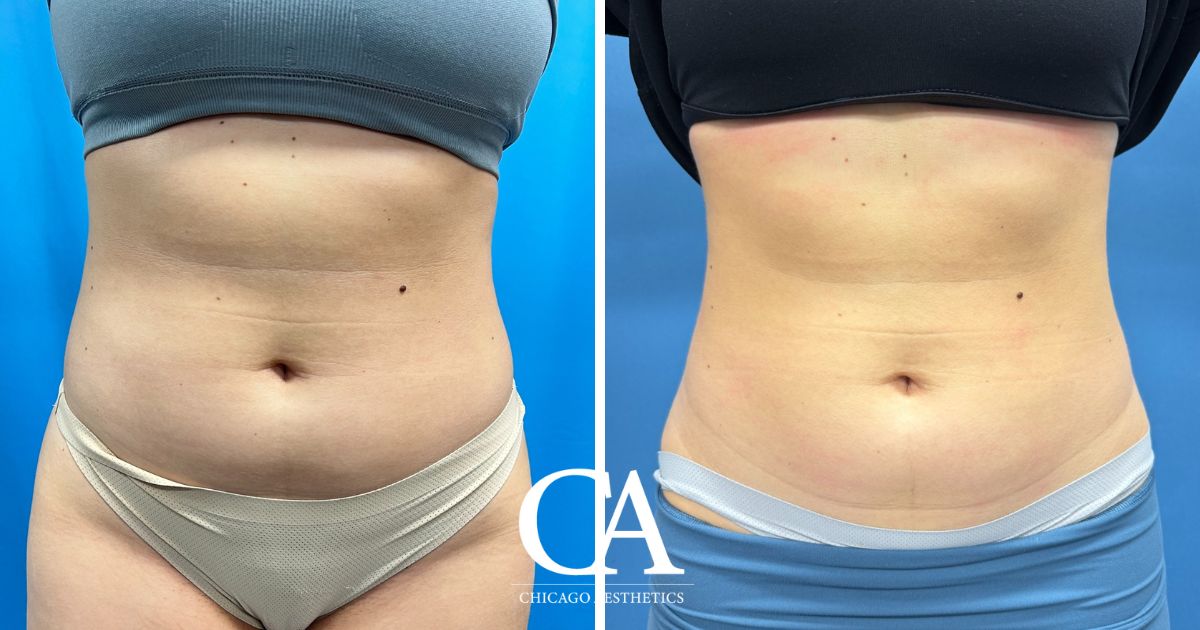 #2030159 Sculpsure before after photo 4 treatments - Chicago Aesthetics