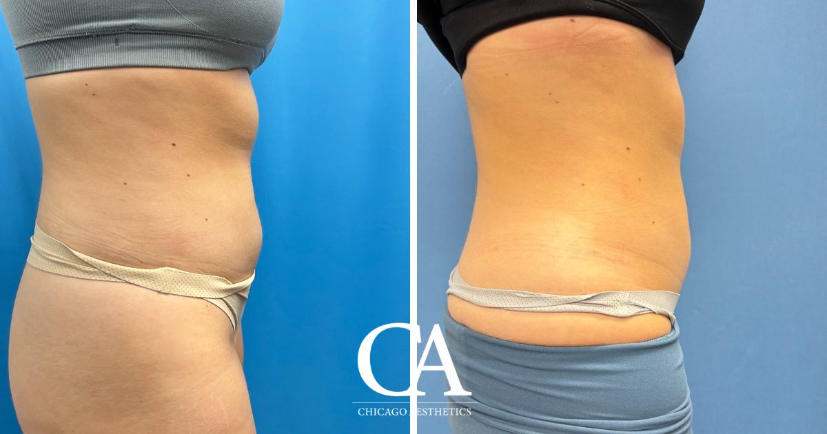 #2030159 Sculpsure before after photo 4 treatments - Chicago Aesthetics