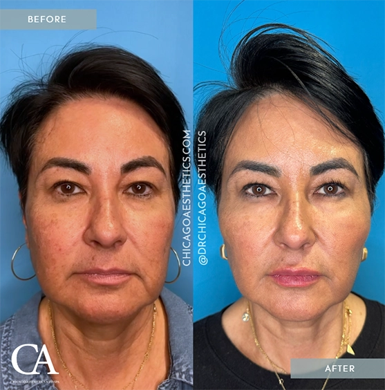 A woman's face before and after dermal fillers or a facelift.