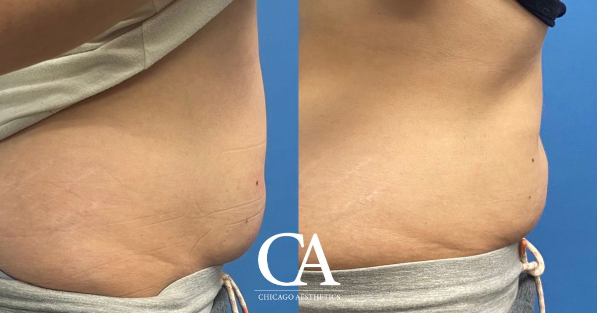 #644 Sculpsure before after photo side 2 - Chicago Aesthetics