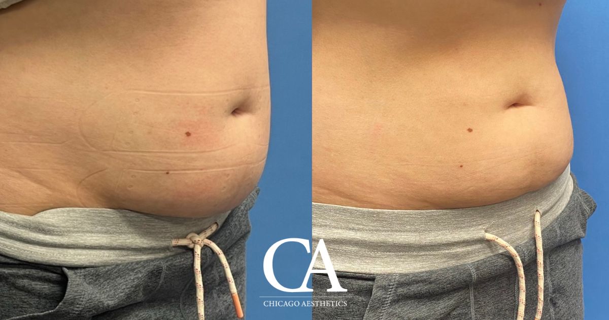 #644 Sculpsure before after photo side - Chicago Aesthetics