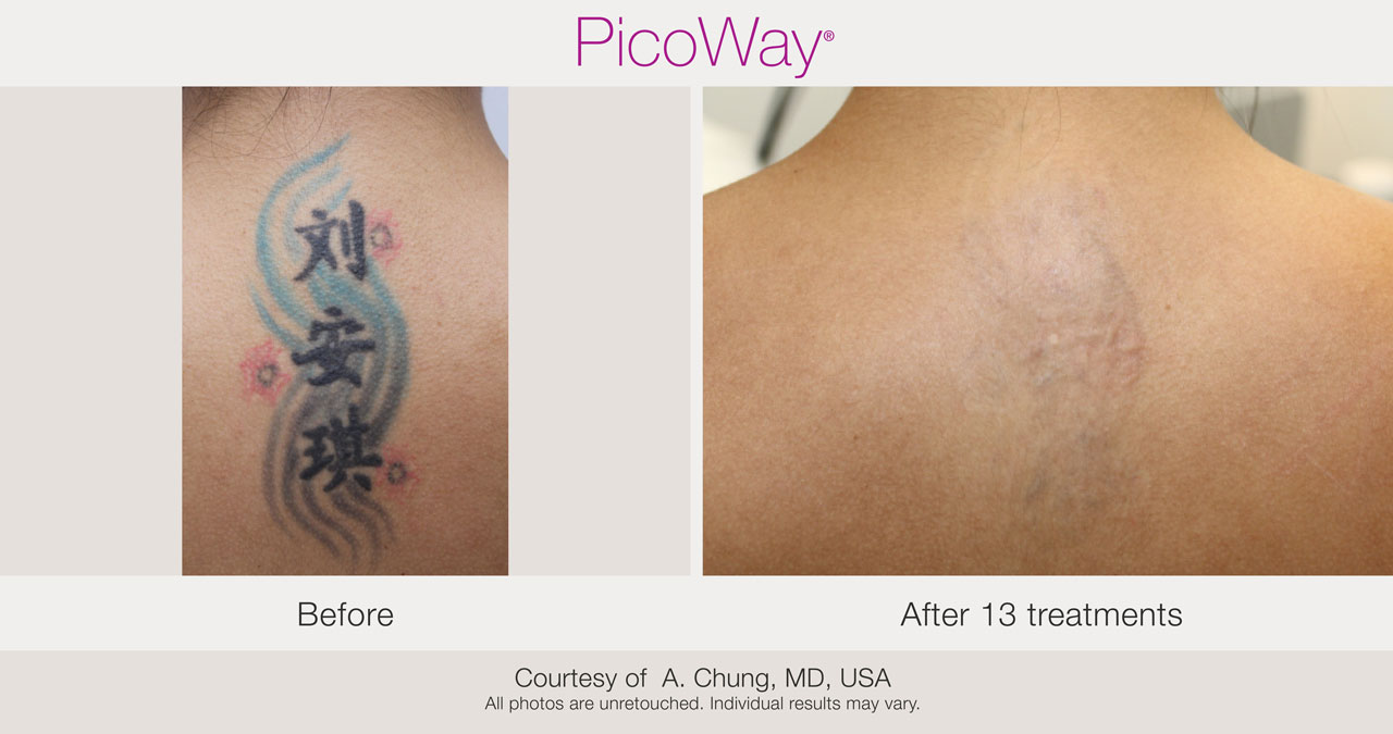 Picoway laser tattoo removal before after photo Chicago Aesthetics