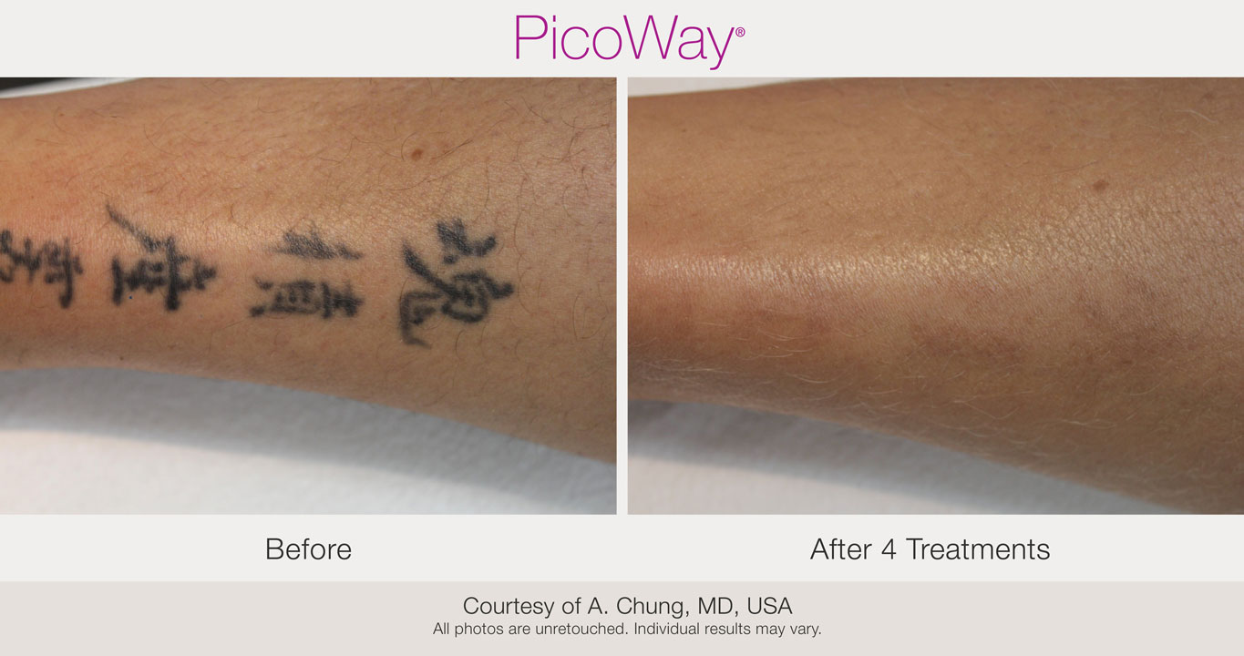 PicoWay tattoo removal at Riverside Medical Arts can help turn the page to  the next chapter in life – St George News