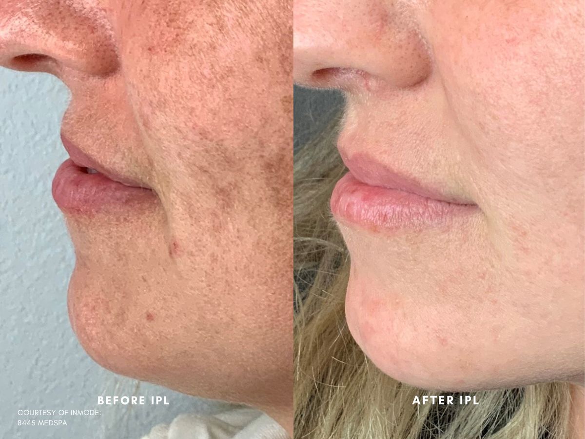 Before and after IPL treatment photos of a woman's skin.