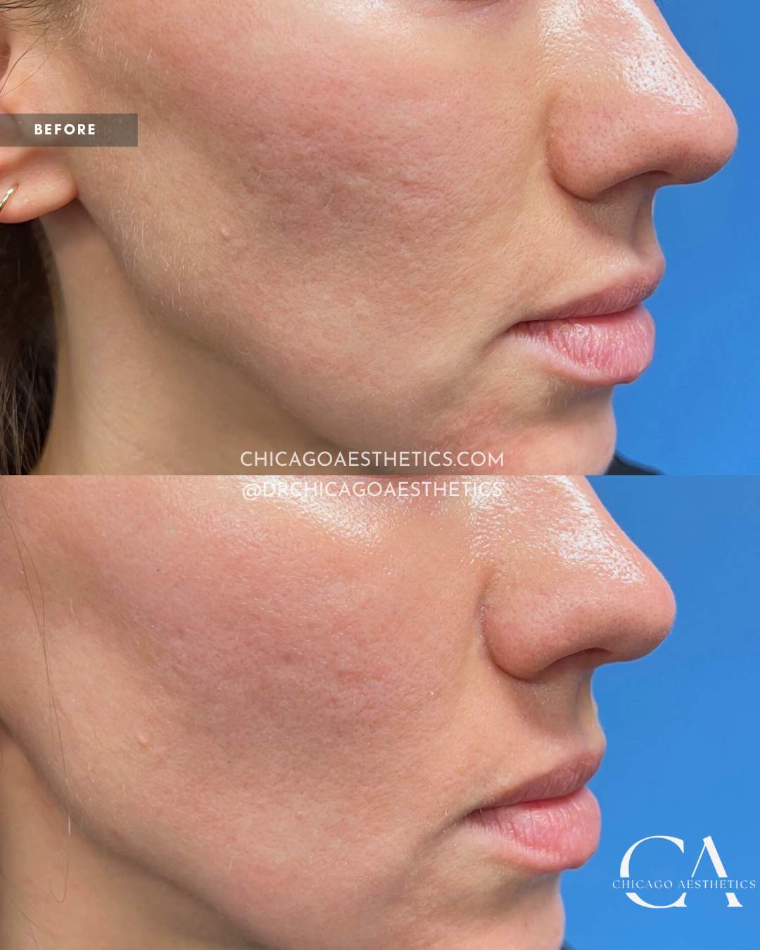 #406 Morpheus8 3 Tx Face Before After Chicago Aesthetics (1)