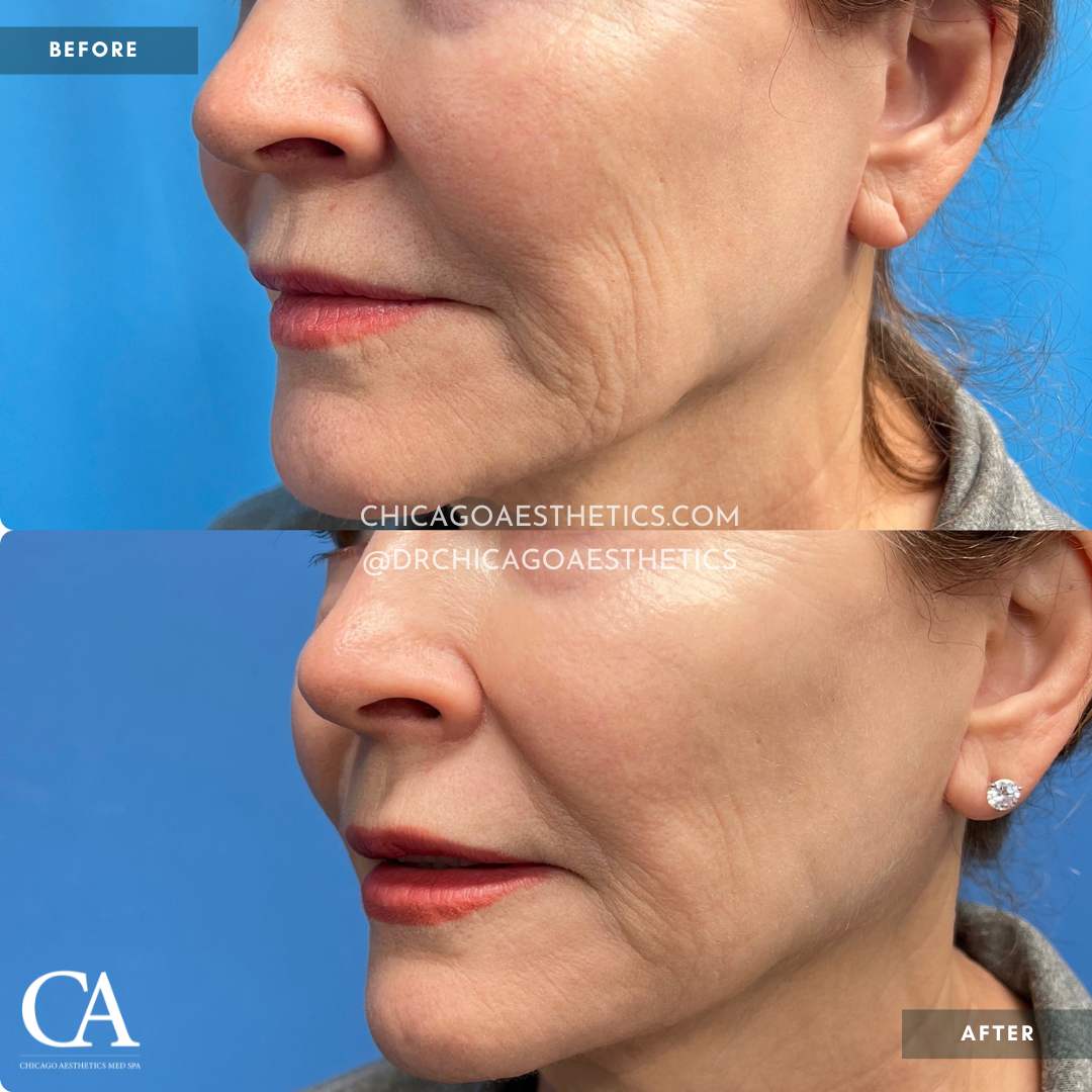 Morpheus8 Face Before After 1966575 Chicago Aesthetics - 5Mos Post