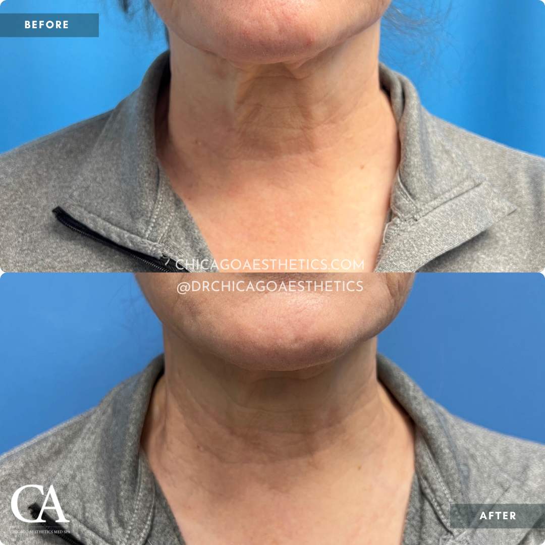 Morpheus8 Face Before After 1966575 Chicago Aesthetics - 5Mos Post