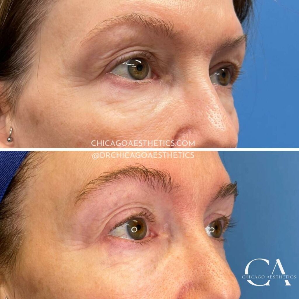 Sofwave Before After Eyes 1996212 Chicago Aesthetics 0