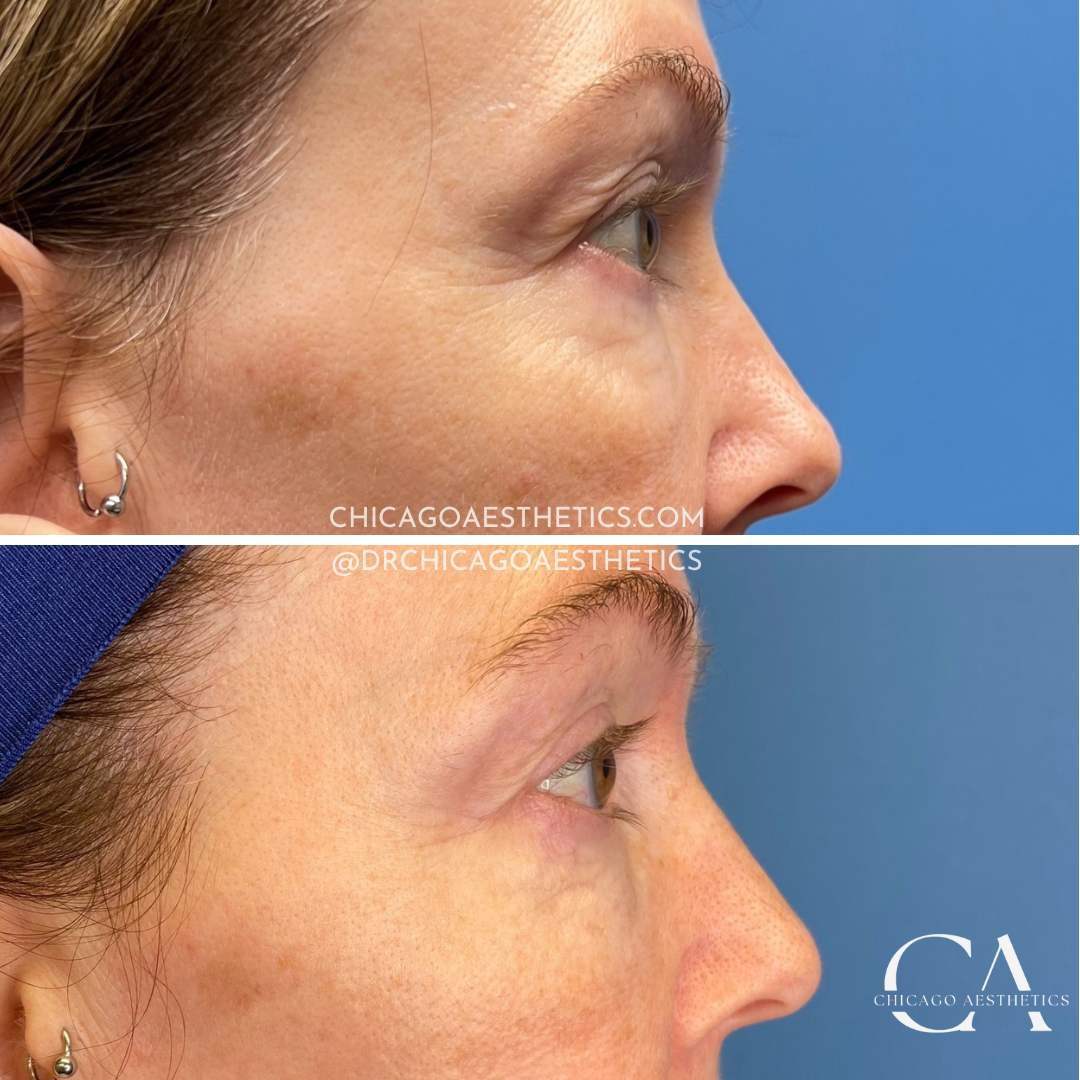 Sofwave Before After Eyes 1996212 Chicago Aesthetics