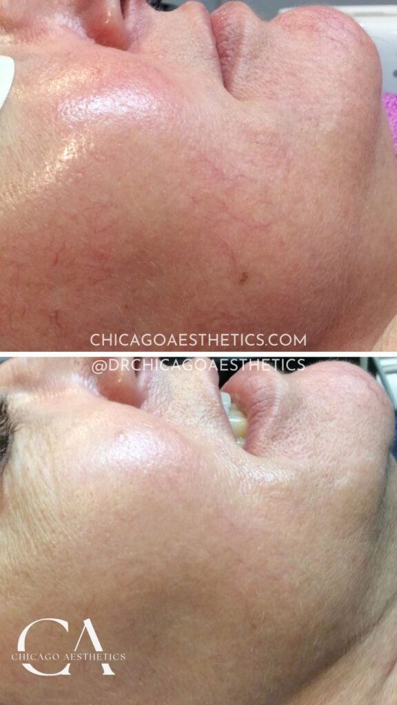 1683307 Ipl Before After Photos 3 Treatments Chicago Aesthetics 0