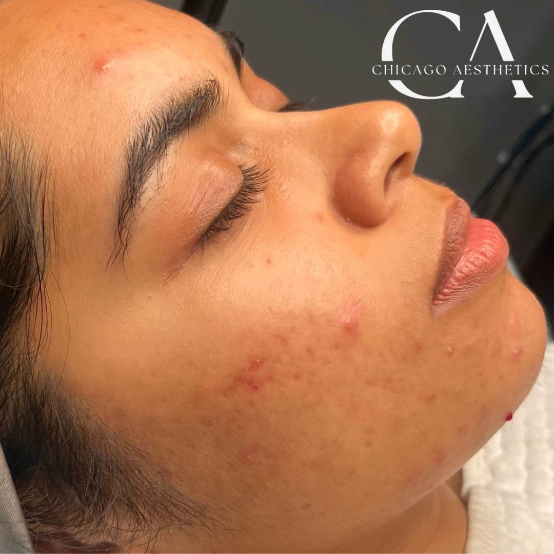 2117804 Hydrafacial Before After Photos Chicago Aesthetics