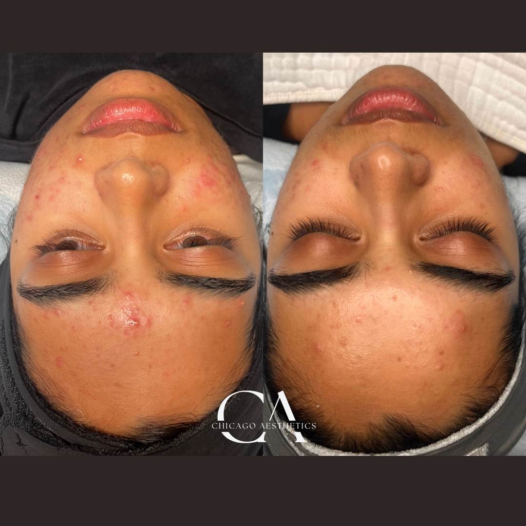 2117804 Hydrafacial Before After Photos Chicago Aesthetics
