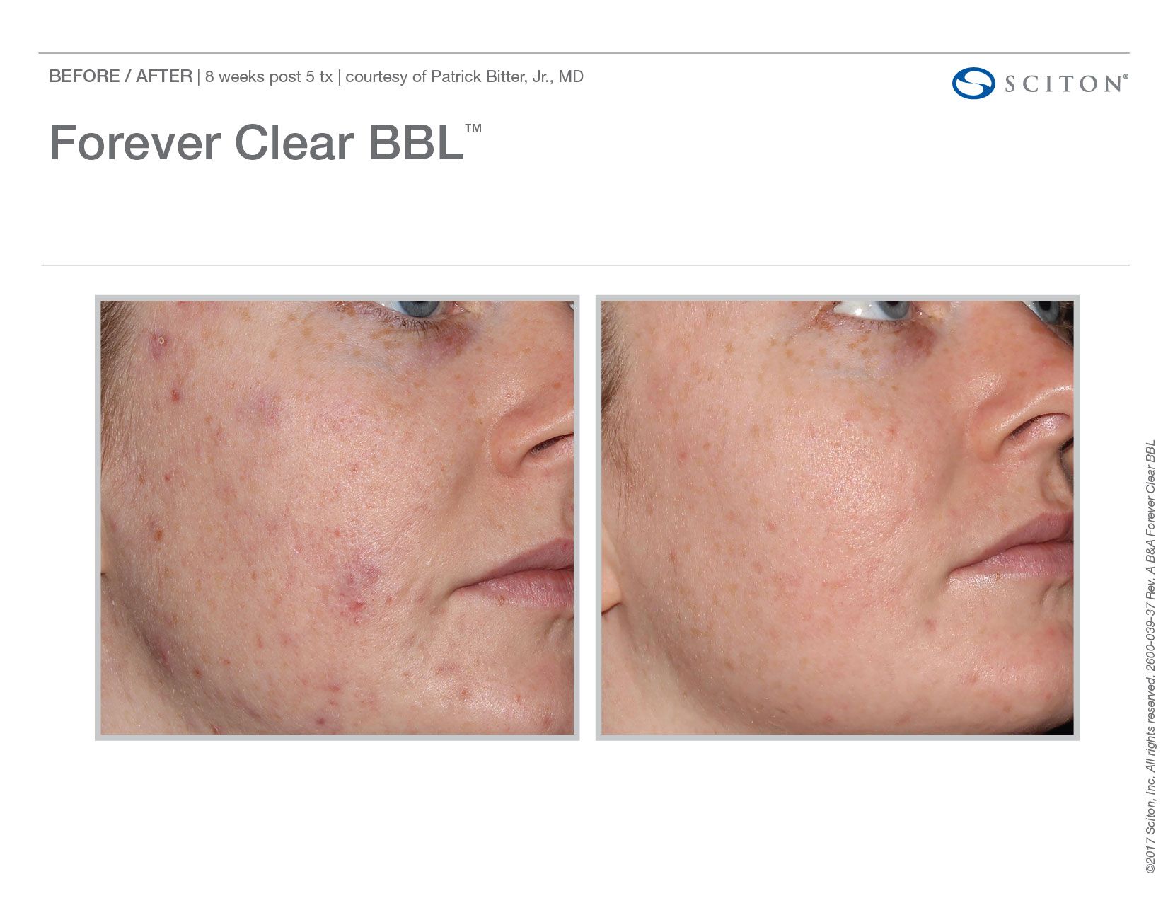 Bbl Forever Clear Before And After Chicago Aesthetics