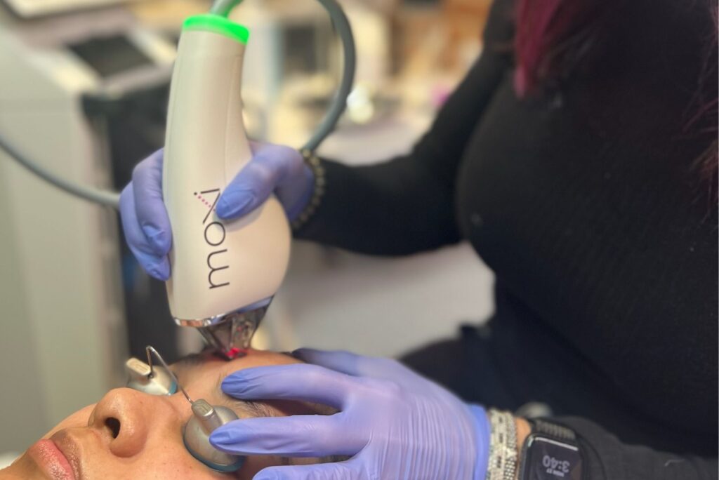 Moxi Laser Treatment For Melasma Chicago Aesthetics