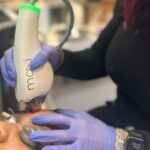Moxi Laser Treatment For Melasma Chicago Aesthetics