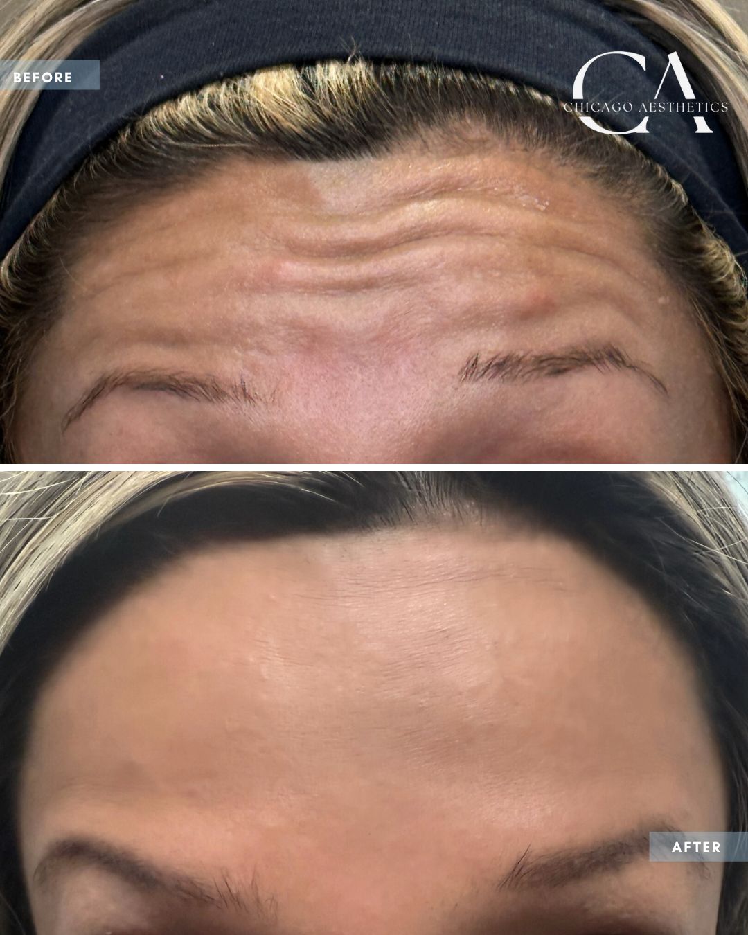 2395102 Forehead Botox Carol Donohue