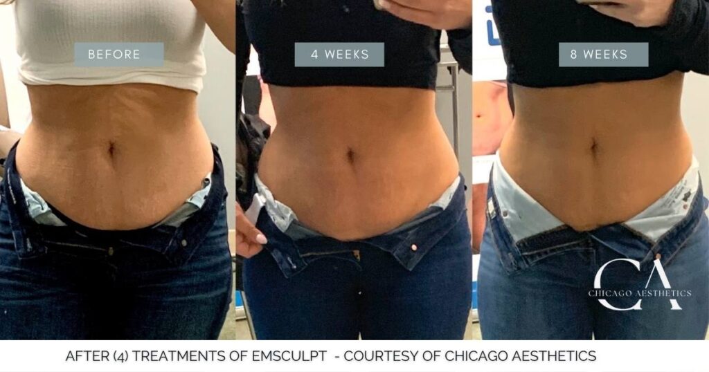 Emsculpt Abs Before After Photo Chicago Aesthetics | Chicago Aesthetic Surgery &Amp; Med Spa
