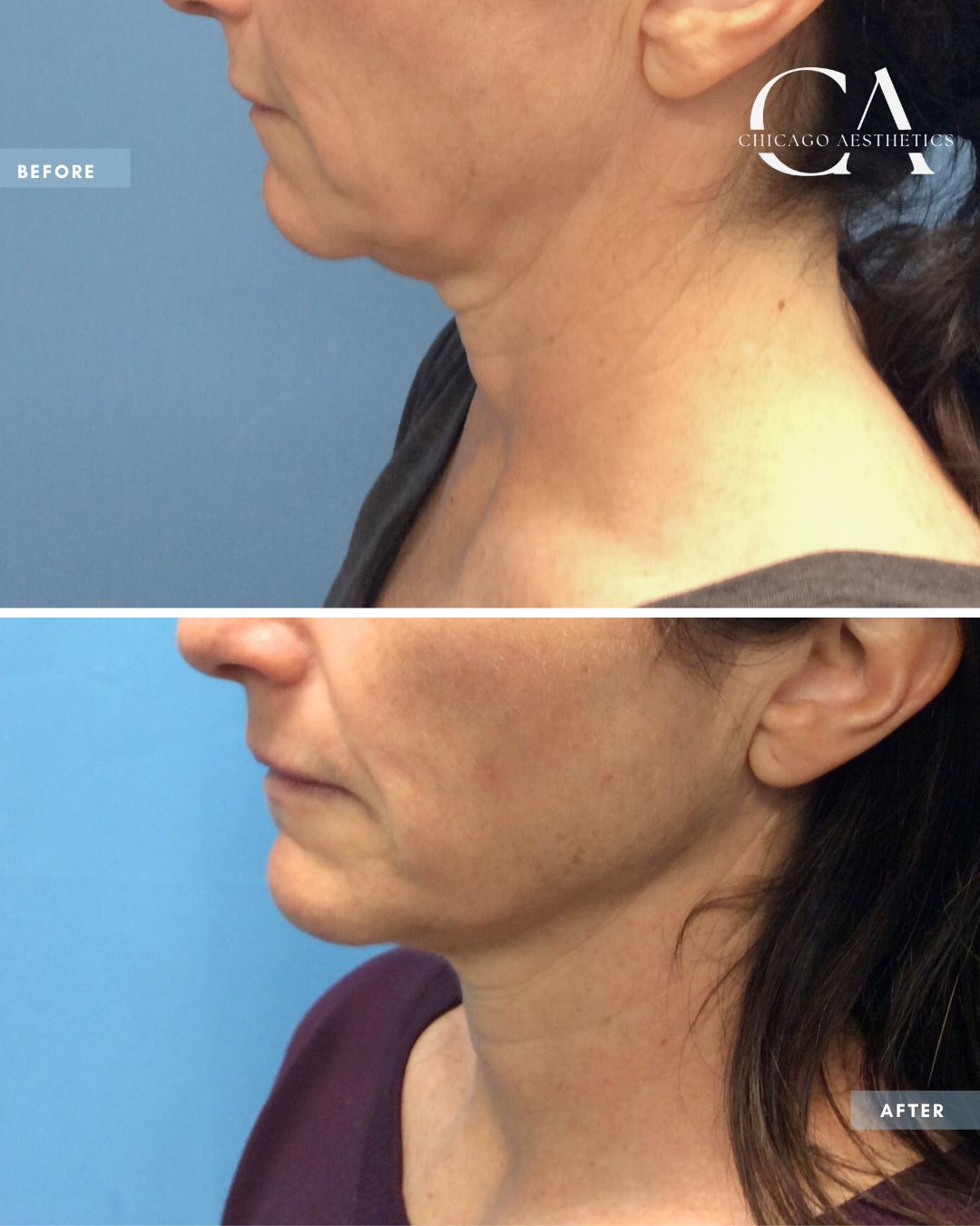 1779252 Sofwave And Morpheus8 Eyelid Lift Alison Falada Chicago