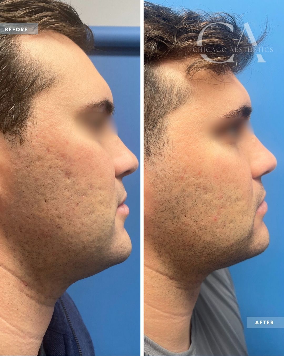 1989010 Morpheus 8 And Ipl Alison Falada Chicago