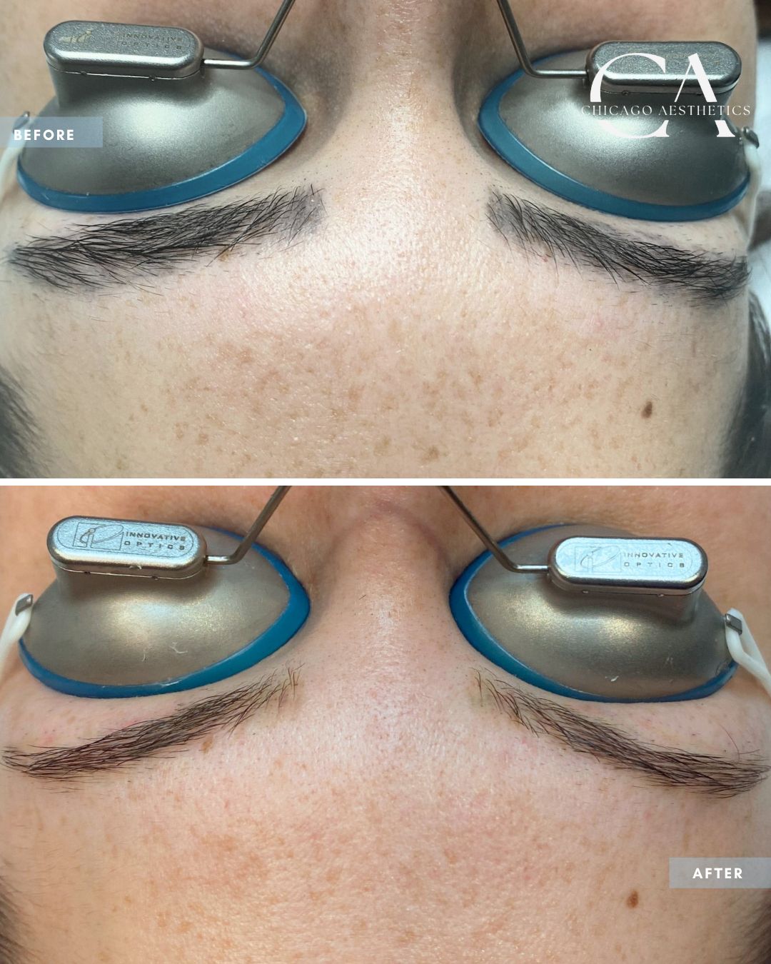 2288606 Laser Tattoo Removal Alison Falada Chicago