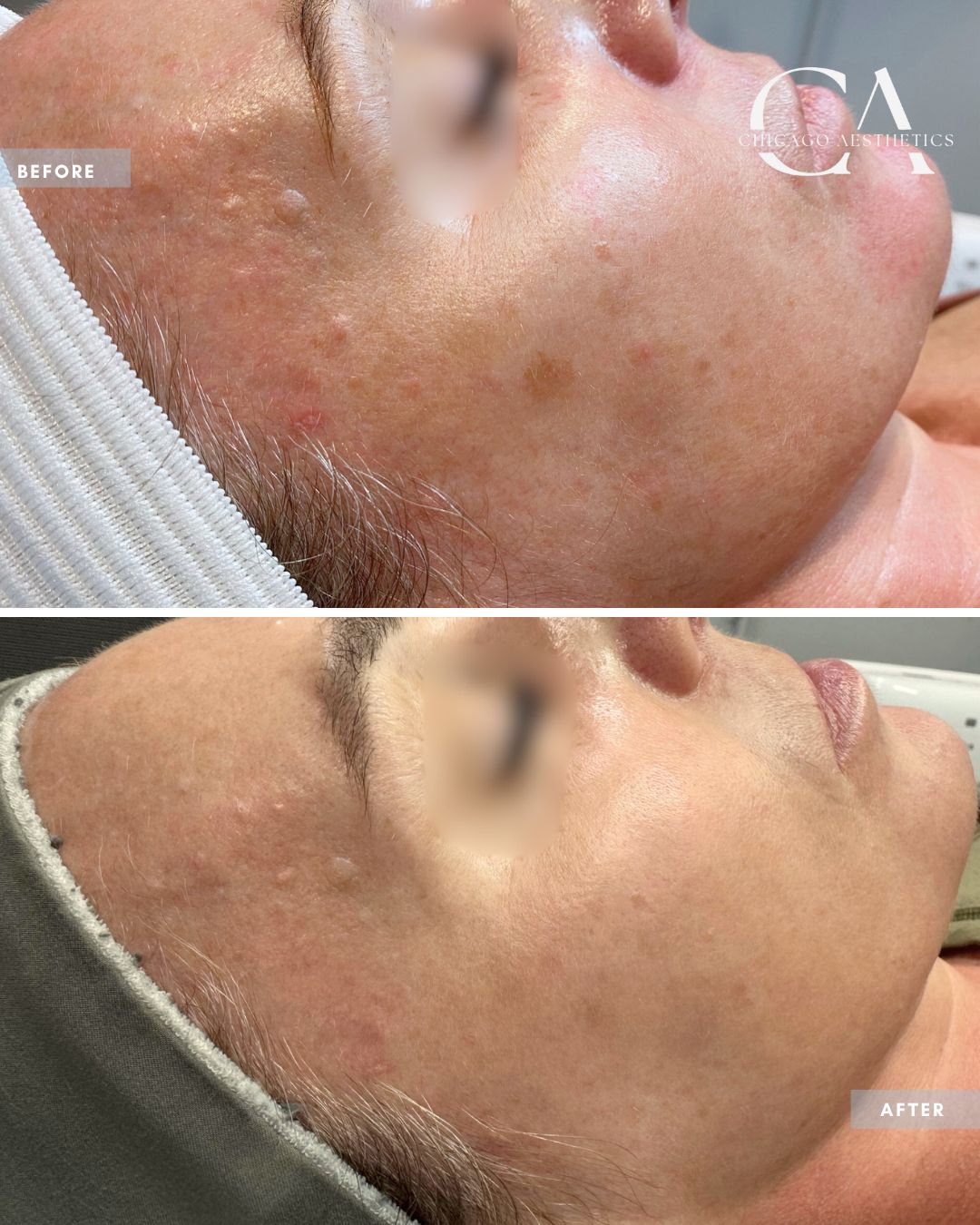 2290353 Moxi Laser Alison Falada Chicago