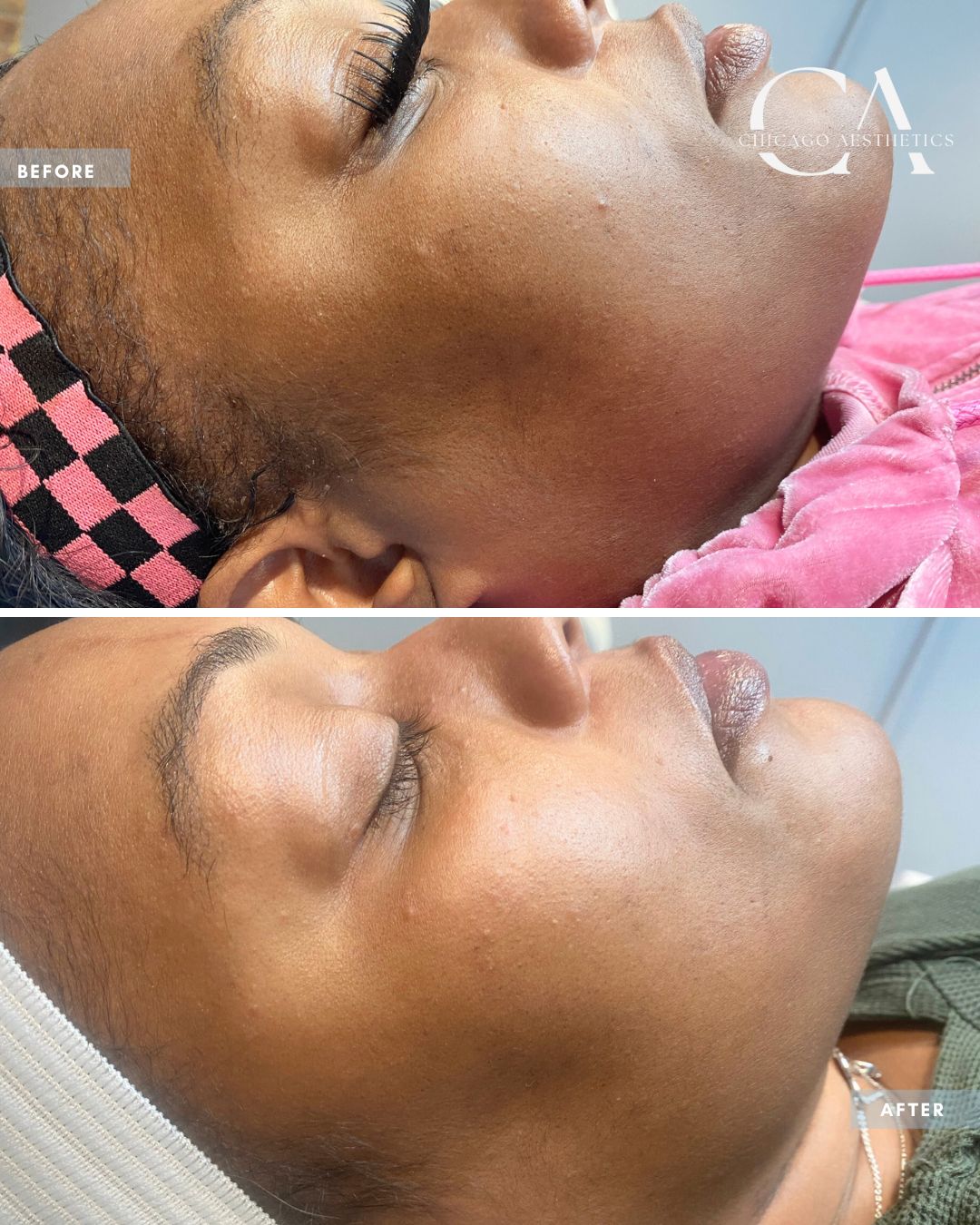 2314779 Chemical Peel Alison Falada Chicago