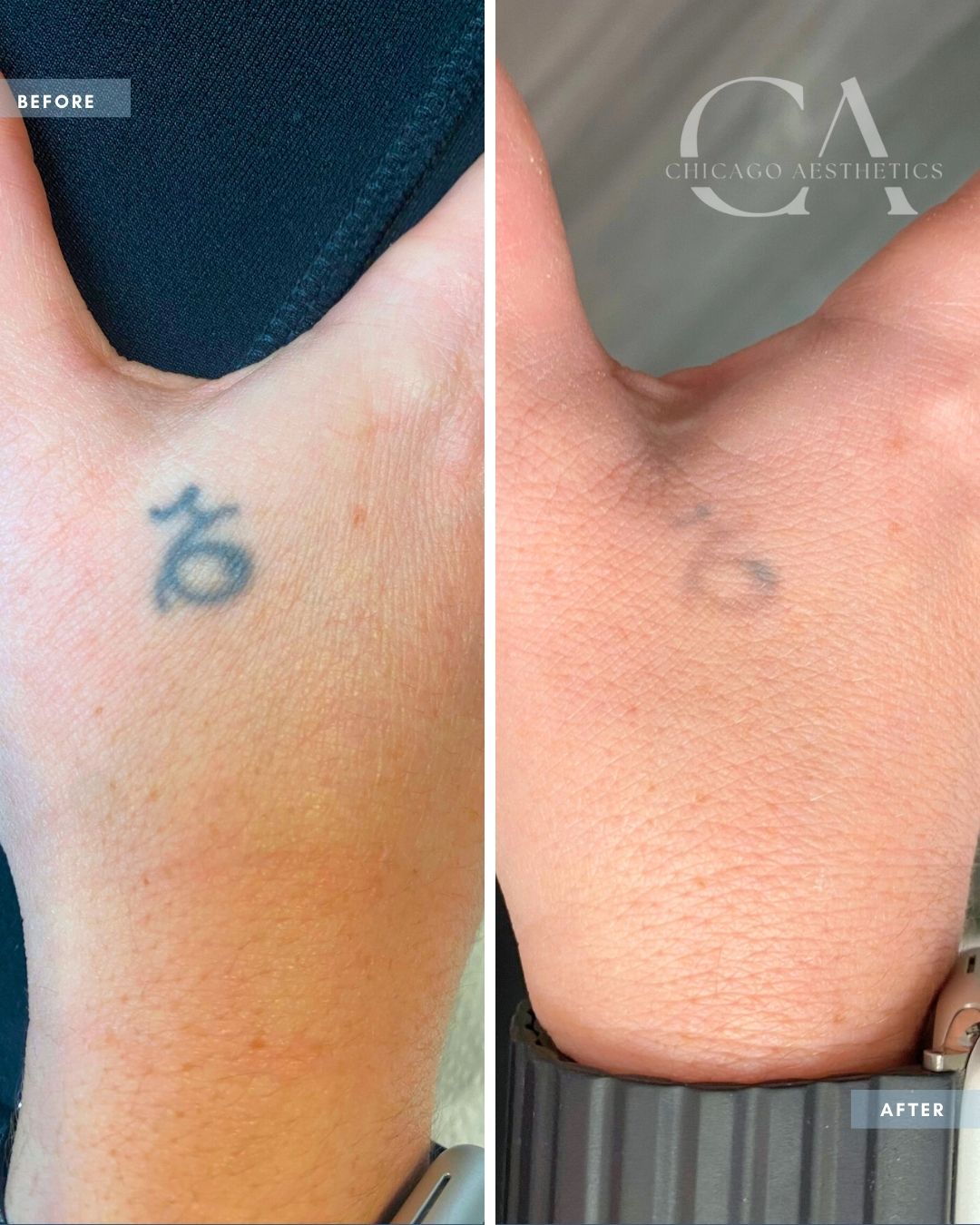 2350414 Laser Tattoo Removal Alison Falada Chicago