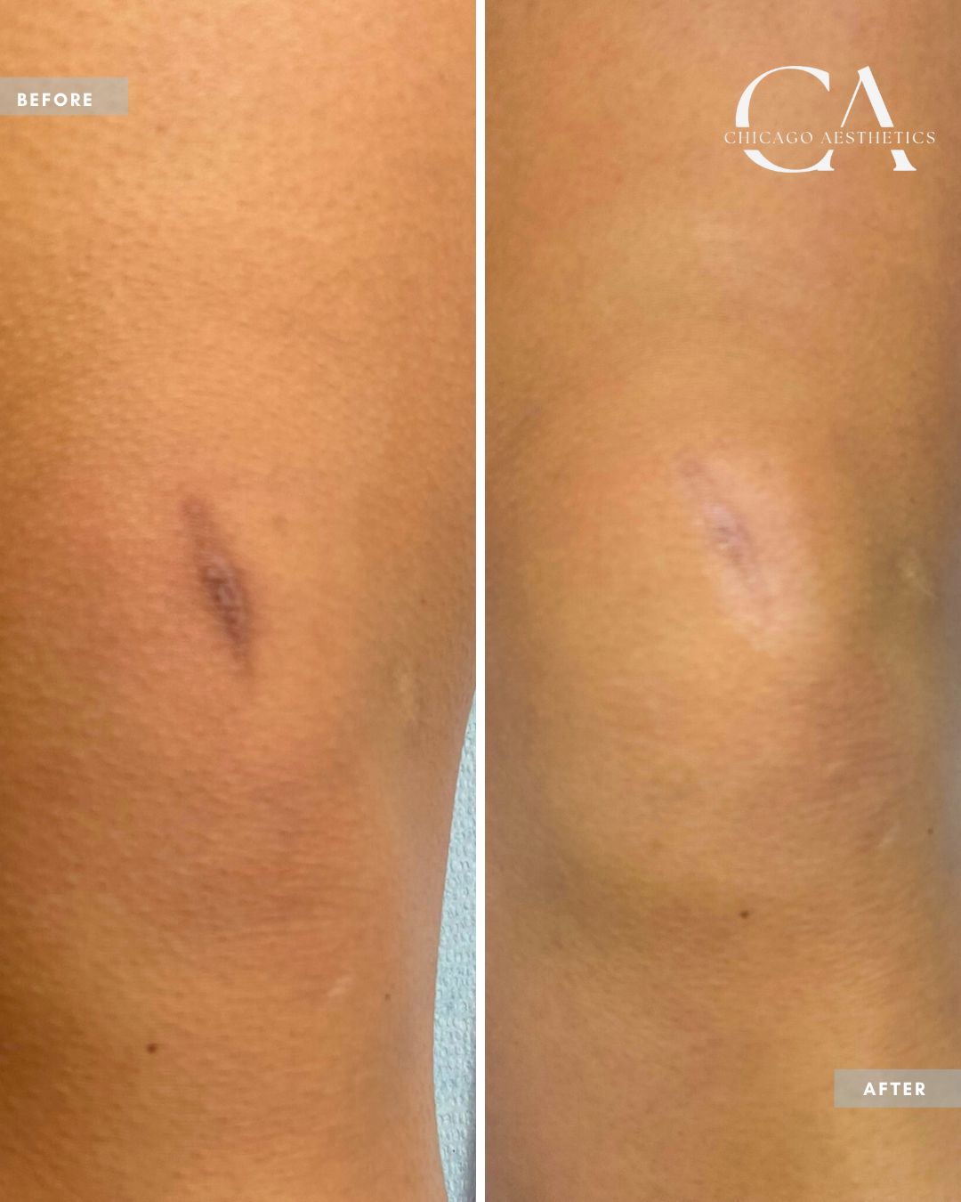 1515100 Moxi Laser Alison Falada Chicago