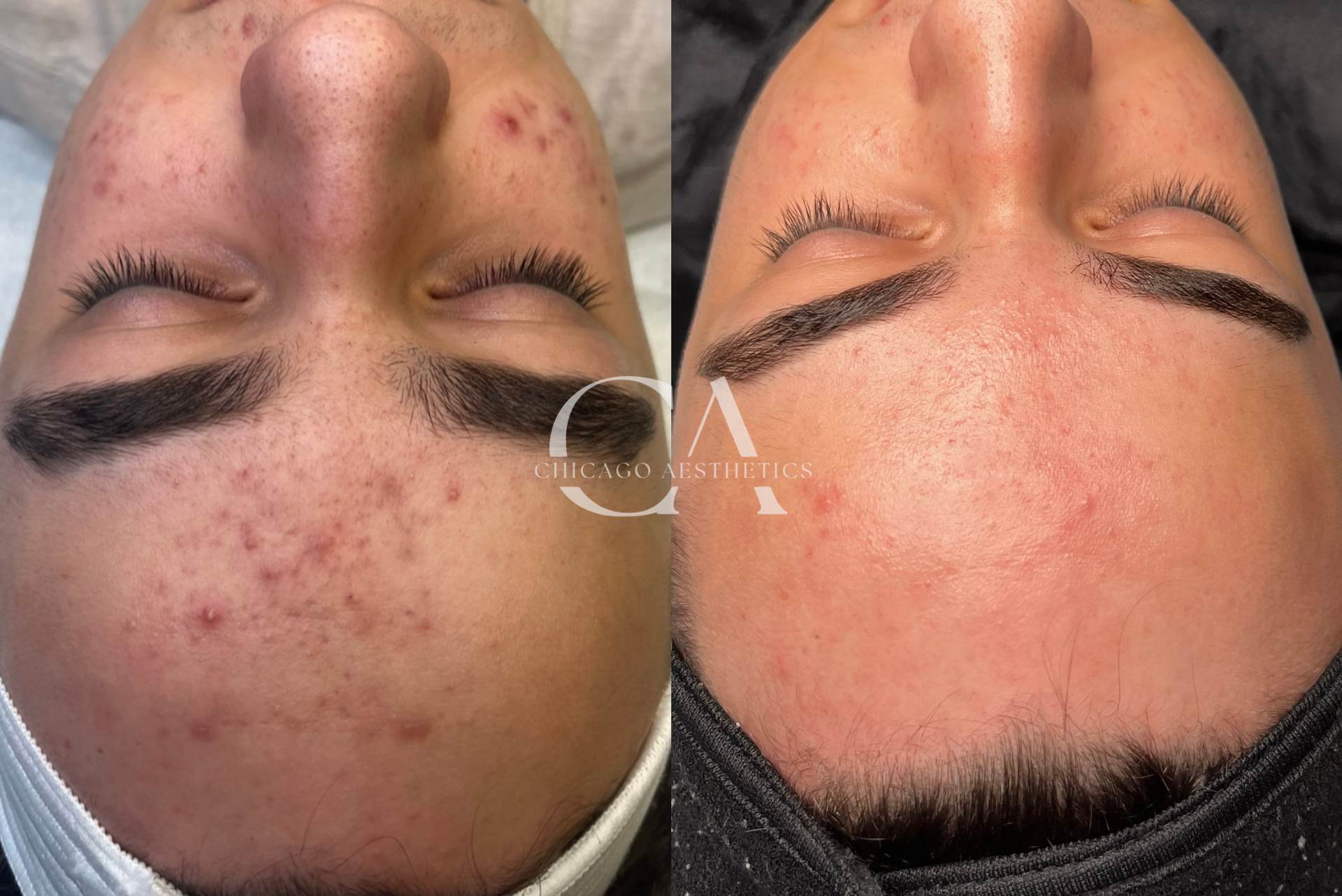 chemical peel before and after photo