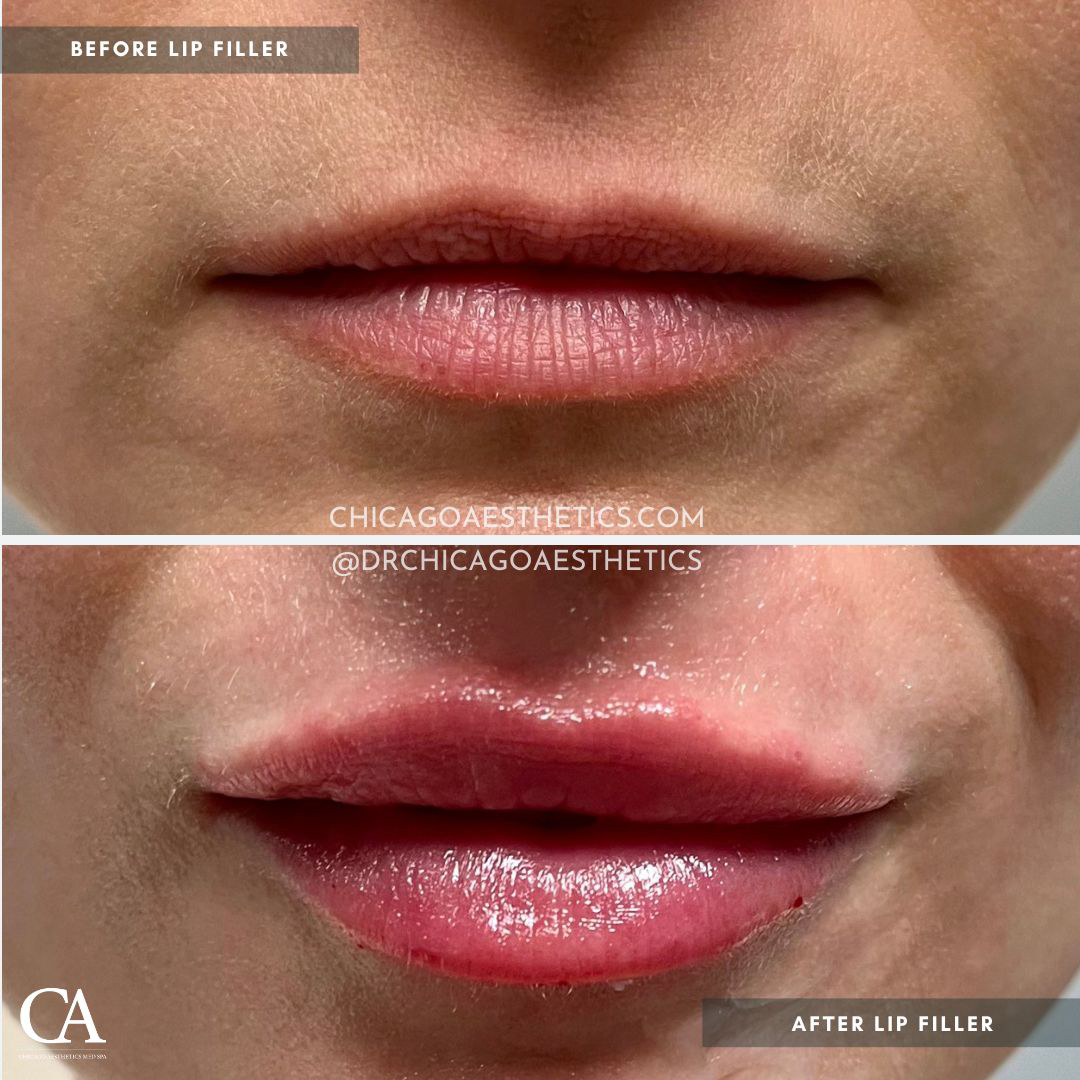 Lip Filler before and after image