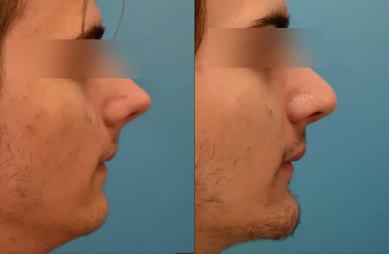 chin augmentation before and after photo by chicago aesthetics surgery & med spa in chicago, il
