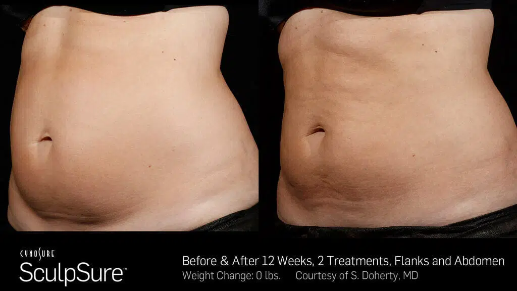 Sculpsure Near Me Chicago