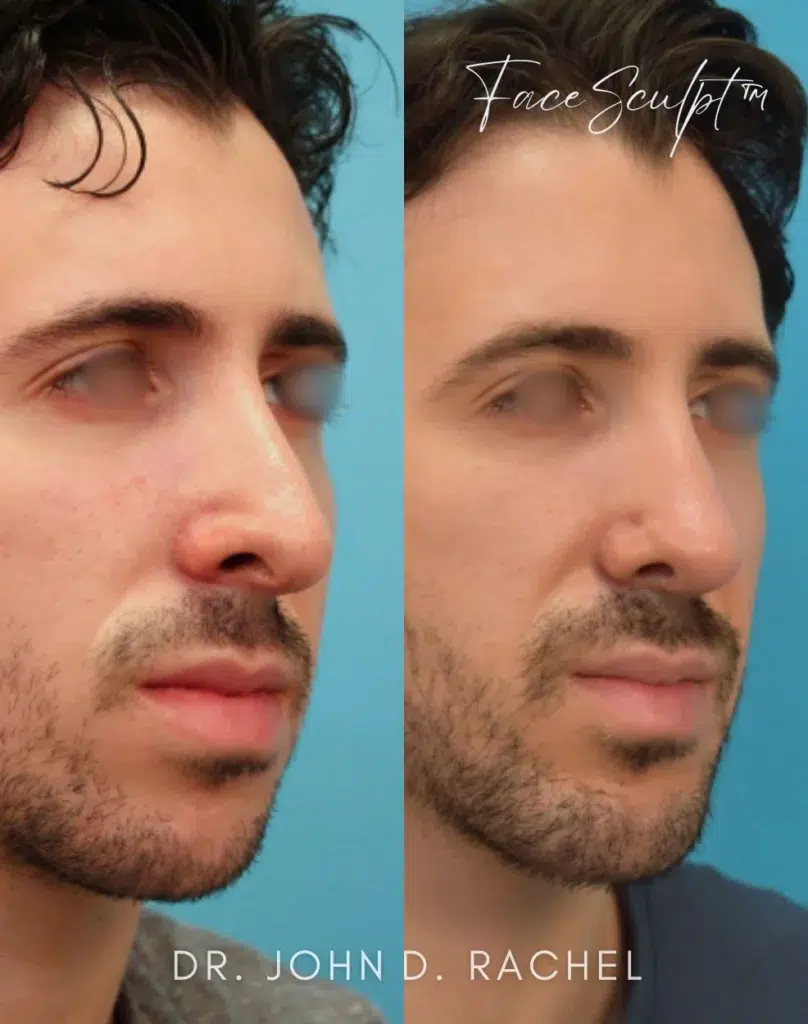 chin augmentation before and after photo by chicago aesthetics surgery & med spa in chicago, il